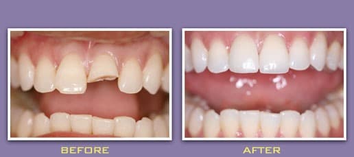 Before and After Image of Porcelain Crowns